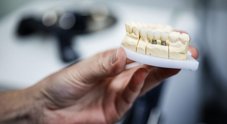 Implanty. Czy można wszczepić implant bezpośrednio po usunięciu zęba?